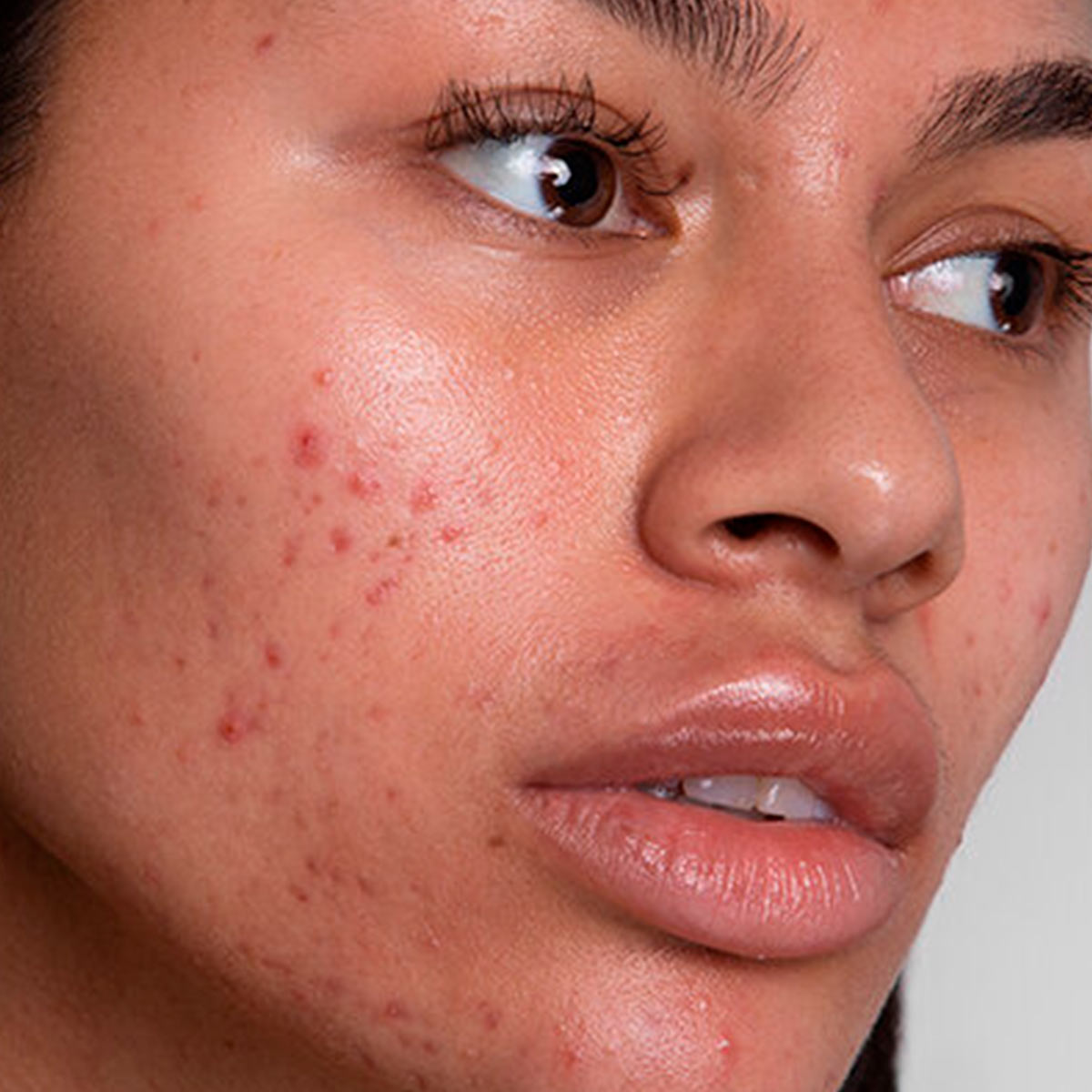 HYPERPIGMENTATION: WHY IT HAPPENS AND HOW TO TREAT IT